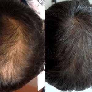 مو کاشت مو بهبود رشد مو کلینیک زیبایی مای رونیکا نعمت آباد لیزر موهای زائد2